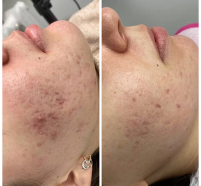 Плазмотерапия Cortexil PRP